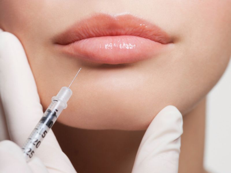 Acide hyaluronique lèvres